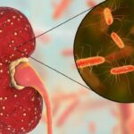 Pielonefritis: causas, síntomas, diagnóstico y tratamiento de una infección renal