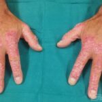 Artritis psoriásica: síntomas, causas, diagnóstico y tratamiento de una enfermedad inflamatoria crónica