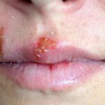 Herpes simple tipo 1: causas, síntomas, diagnóstico, tratamiento y prevención