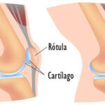 Condromalacia rotuliana: causas, síntomas, diagnóstico y tratamientos para aliviar el dolor de rodilla