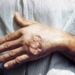 Leishmaniasis: causas, síntomas, diagnóstico, tratamiento y prevención de esta enfermedad parasitaria