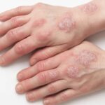 Artritis psoriásica