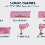 Diarrea crónica: una alteración digestiva que puede afectar la salud y la calidad de vida