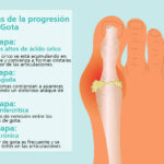 Gota: causas, síntomas, tratamiento y prevención de una enfermedad inflamatoria de las articulaciones